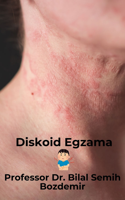 Diskoid Egzama (Basılı, Adrese Teslim)